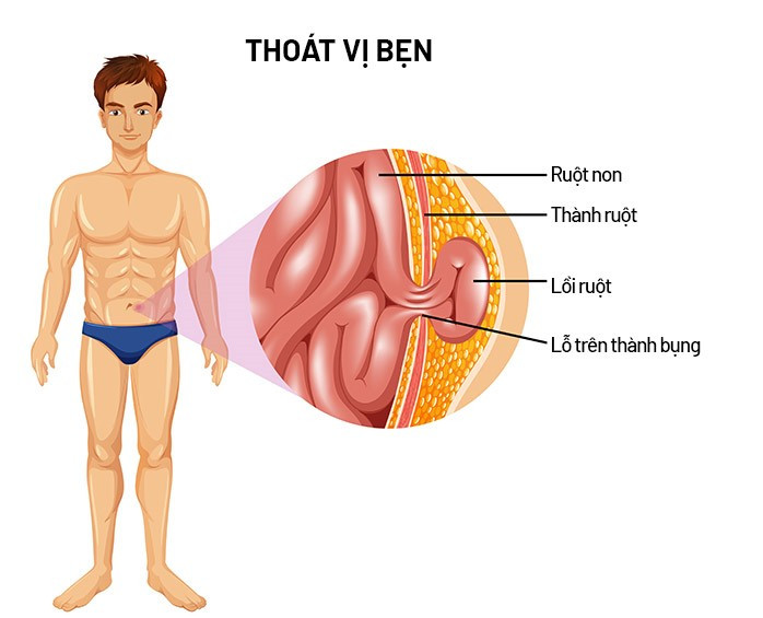Thoát vị bẹn là bệnh lý lành tính, chỉ gây khó chịu cho người bệnh. Tuy nhiên, bệnh thường phát triển theo thời gian và nếu không được điều trị sớm có thể gây biến chứng nguy hiểm.