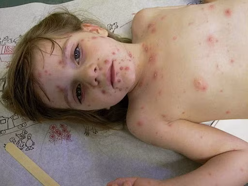 Zona là bệnh nhiễm trùng da do virus Varicella zoster (VZV) gây ra, VZV cũng là virus gây bệnh thủy đậu.