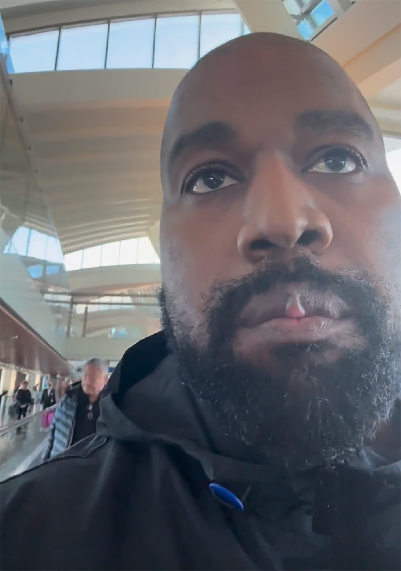 Phần môi dị dạng của Kanye West sau khi lắp răng giả. Phần môi dị dạng của Kanye West sau khi lắp răng giả.