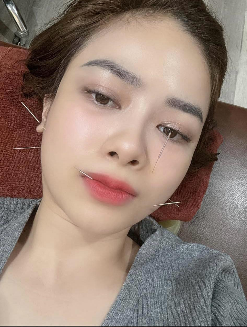 Dương Hoàng Yến chia sẻ ảnh châm cứu và nhập viện điều trị liệt dây thần kinh số 7. Dương Hoàng Yến chia sẻ ảnh châm cứu và nhập viện điều trị liệt dây thần kinh số 7.