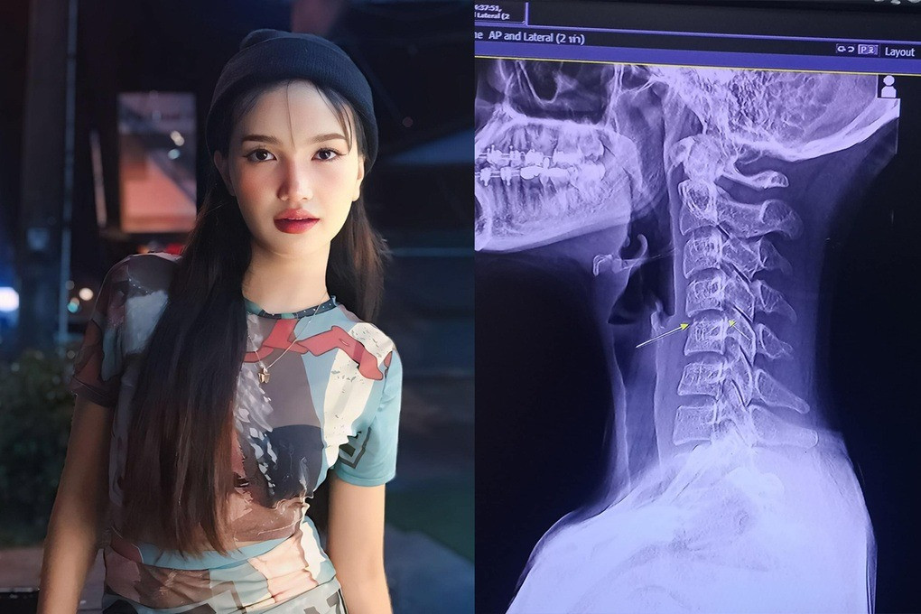 Kết quả MRI cho thấy Ping Chayada không bị gãy xương, tổn thương do massage. Kết quả MRI cho thấy Ping Chayada không bị gãy xương, tổn thương do massage.