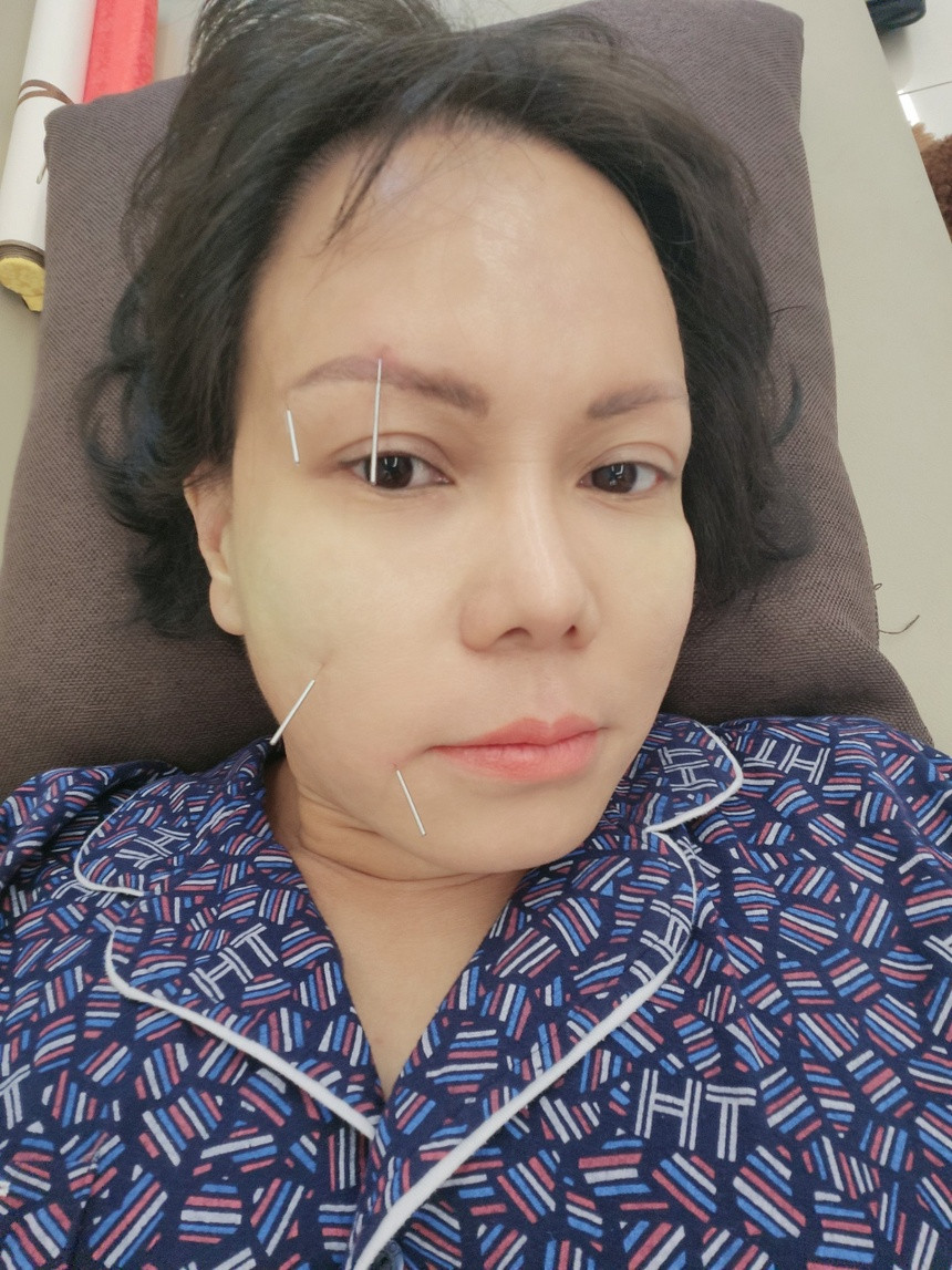 Tình hình sức khỏe của Việt Hương tạm ổn sau khi được châm cứu.