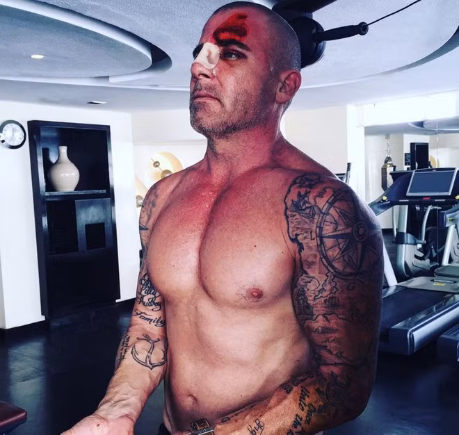 Sau vai diễn anh trai của Michael Scofield, Dominic Purcell có thêm vai diễn trong Legends of Tomorrow và The Flash. Tuy nhiên, tên tuổi của nam diễn viên không vượt khỏi series Vượt ngục. Đó là lý do sau khi series trở lại năm 2017 sau 8 năm "đắp chiếu", anh nhận lời trở lại. Trong ảnh, nam diễn viên bị thương trên phim trường Vượt ngục 5.
