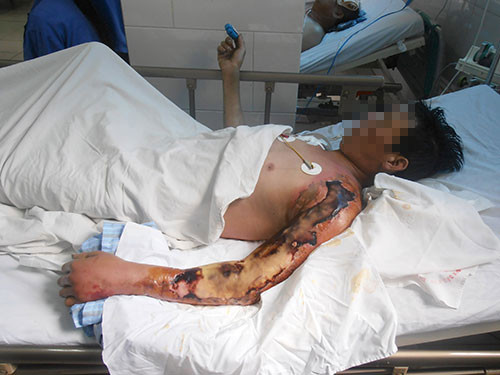 Một bệnh nhân bị vi khuẩn Aeromonas Hydrophyla 