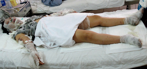 Chị Nguyễn Thị Luyến bị bỏng % cơ thể