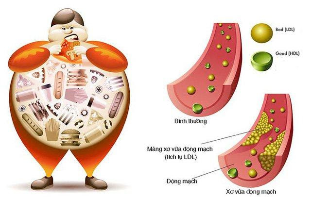 Fast food chứa Cholesterol có hại (LDL) gây đột quỵ ở giới trẻ