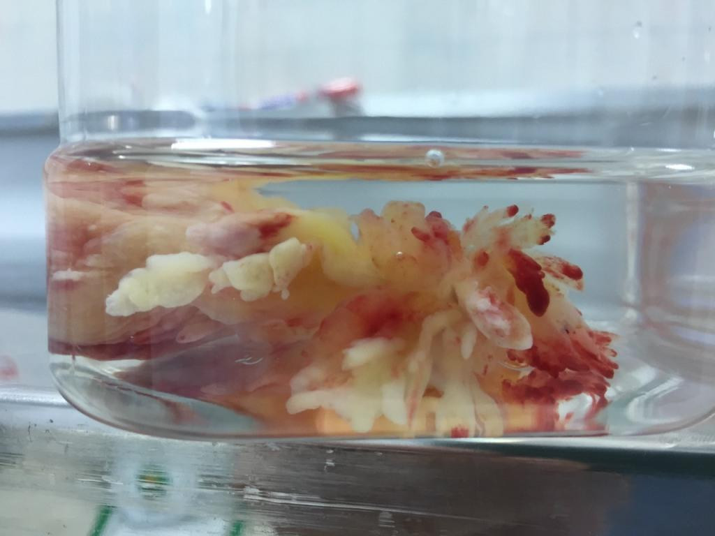 Hình ảnh khối u sau khi được lấy ra