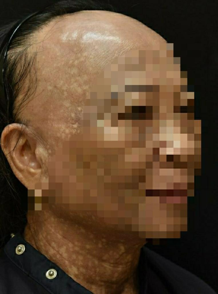 Nữ bệnh nhân bỗng rụng róc, xơ hóa vùng trán kèm sạm da (ảnh: BVCC)