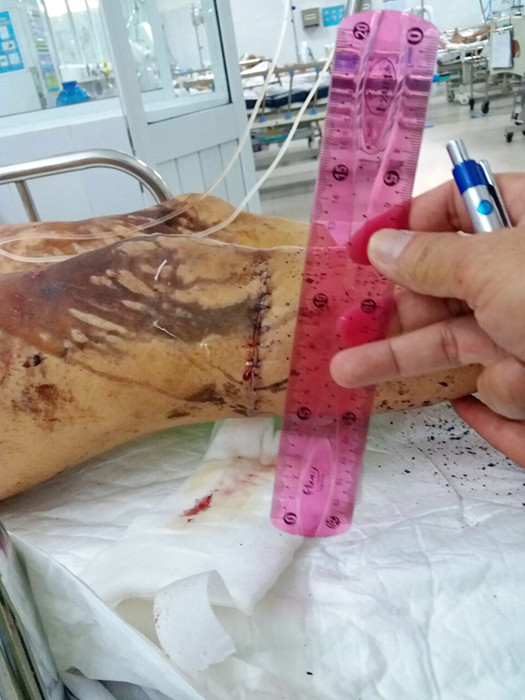 Một vụ tạt axit, hủy hoại thân thể gây rúng động Quảng Ngãi ảnh 2