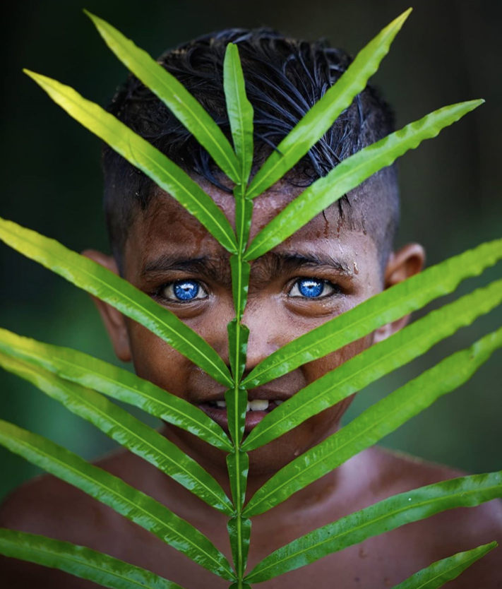 Đôi mắt biếc của cậu bé mắc hội chứng Waardenburg