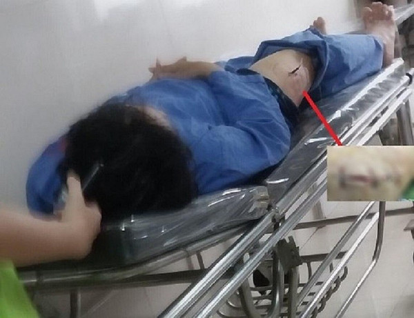 Thời điểm ông G. bị thương được đưa đi cấp cứu tại bệnh viện.