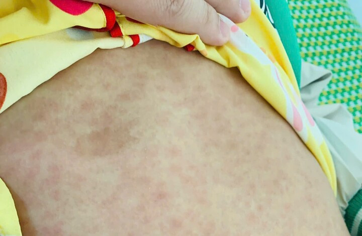 Dịp nghỉ Tết Nguyên đán 2025, ngành y tế huyện Nam Trà My tiếp nhận và điều trị 43 trẻ có triệu chứng sốt phát ban. Ảnh VM