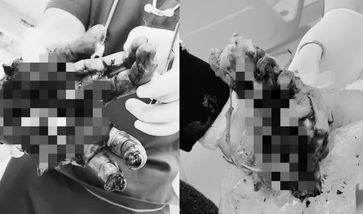 Hình ảnh hai bàn tay dập nát sau tai nạn pháo nổ. Ảnh BV