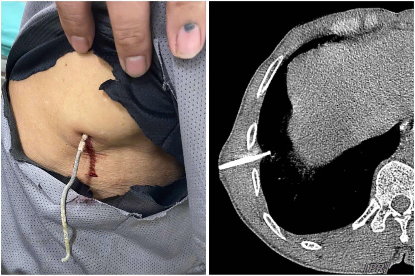 Dị vật được xác định là kẽm thường được làm hàng rào găm vào xuyên thủng phổi phải người bệnh V.A. Dị vật được xác định là kẽm thường được làm hàng rào găm vào xuyên thủng phổi phải người bệnh V.A.