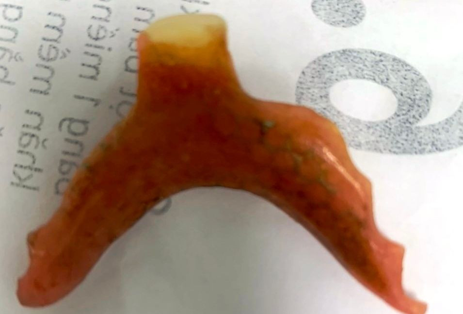 Dị vật là chiếc răng giả của ông Ph. được phẫu thuật nội soi lấy ra từ thực quản. Ảnh BV Dị vật là chiếc răng giả của ông Ph. được phẫu thuật nội soi lấy ra từ thực quản. Ảnh BV