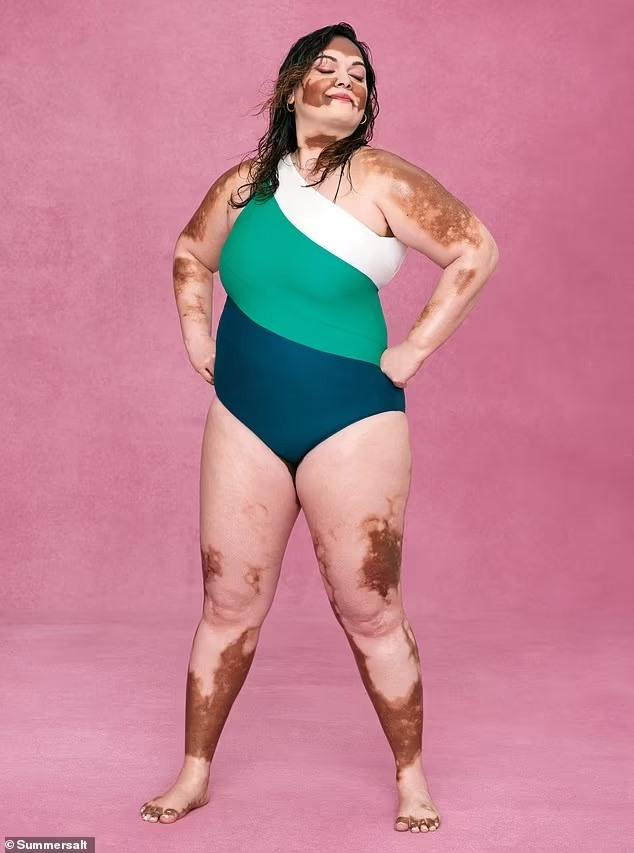 Người mẫu bạch biến ngoại cỡ Andrea Thomas.