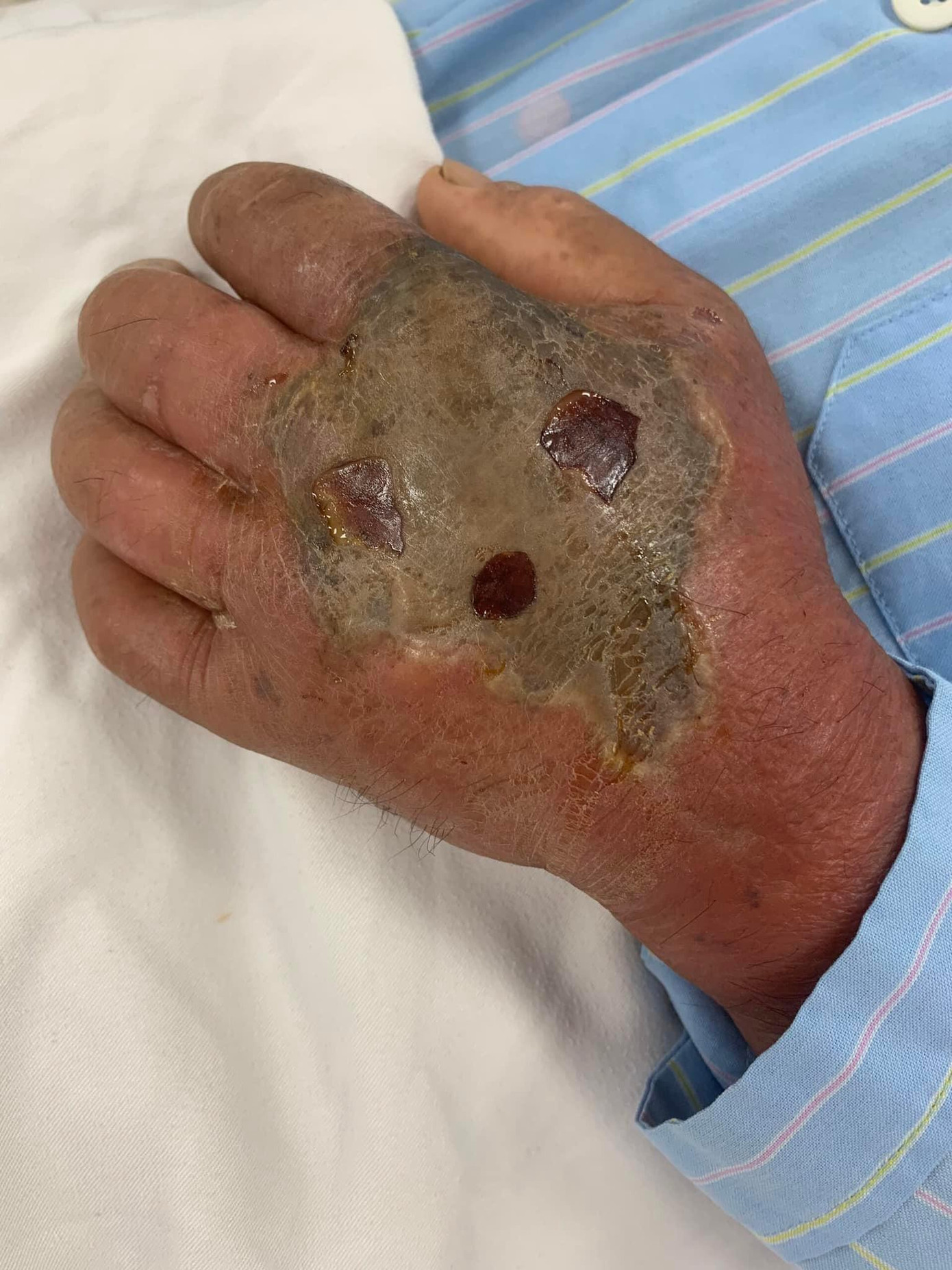 Bàn tay người bệnh bị hoại tử, nhiễm trùng nặng do rắn độc cắn. Ảnh: BS cung cấp