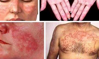 Lupus ban đỏ hệ thống có nguy hiểm?