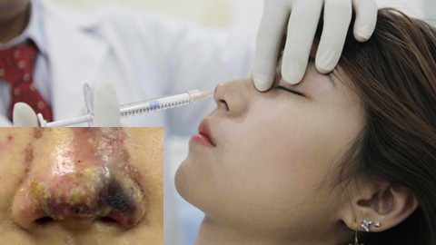 Tiêm filler: Sau công dụng 'thần tiên', làm nhanh giá rẻ là ẩn họa khôn lường! ảnh 2
