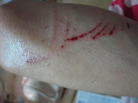 Vết thương trên tay sau trận đòn bất thình lình. Vết thương trên tay sau trận đòn bất thình lình