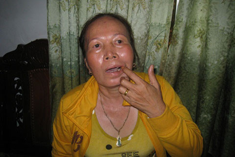 Bà Lý tố bị ông Sót đánh gãy 4 chiếc răng. Bà Lý tố bị ông Sót đánh gãy 4 chiếc răng