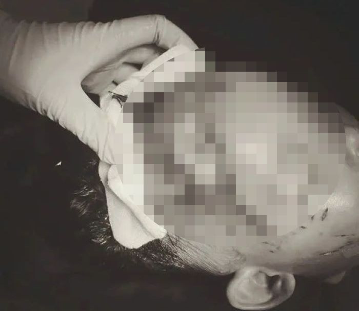 Vết thương trên đầu cháu H. do chó cắn.