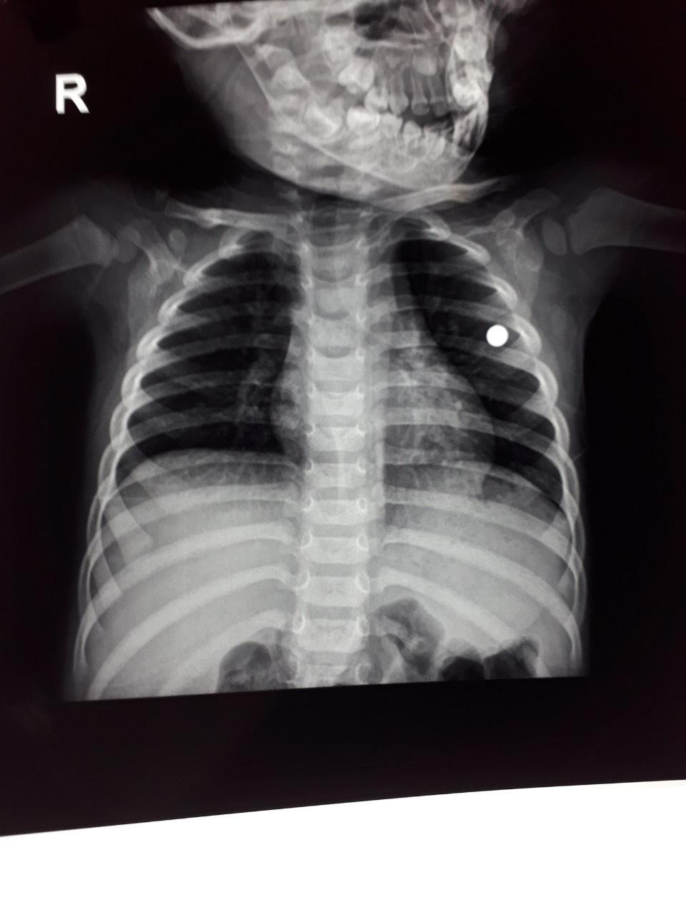 Viên đạn trong ngực trái của cháu bé. Ảnh do Bệnh viện Nhi Thanh Hoá cung cấp