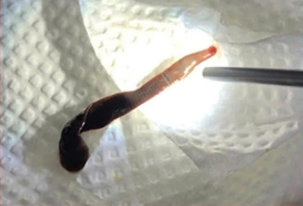 Con vắt dài 8cm được lấy ra từ mũi bệnh nhân Q.