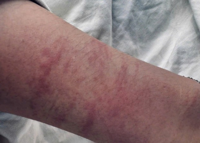 Chị H. bị trầy xước ở tay trong lúc bị xâm hại