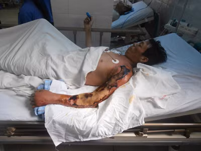 Bệnh nhân Ph.V.T. khi đang điều trị tại BV Bệnh Nhiệt đới T.Ư