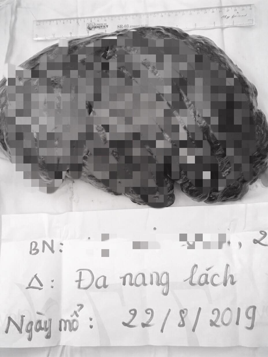 Lấy thành công khối đa nang lách dài nửa mét trong bụng người phụ nữ ảnh 2