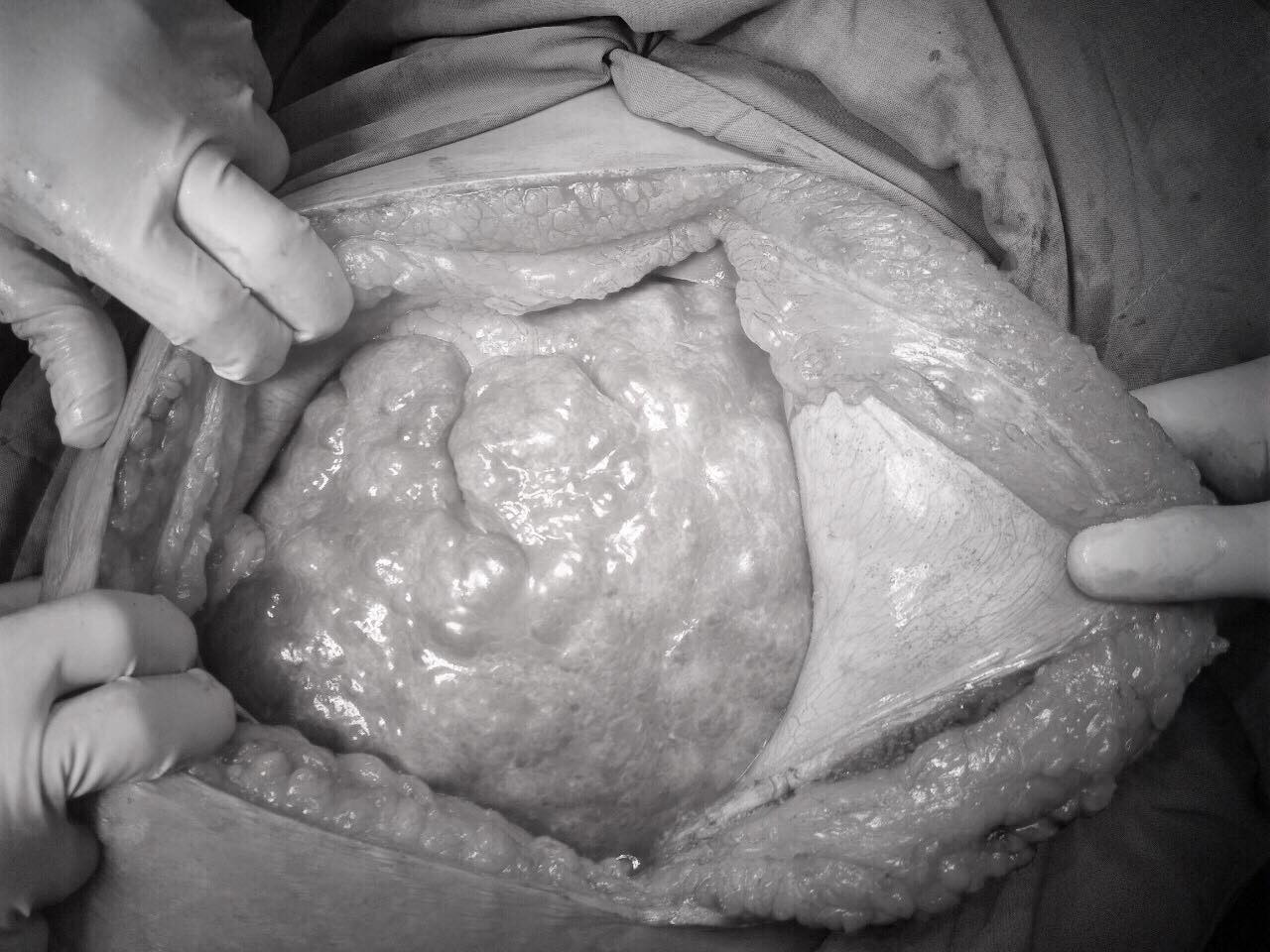 Lấy thành công khối đa nang lách dài nửa mét trong bụng người phụ nữ ảnh 3