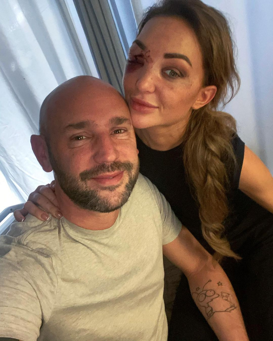 Hình ảnh Hoa hậu Hoàn vũ Bỉ Chayenne Van Aarle sau tai nạn.