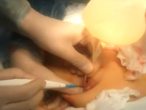 Một ca phẫu thuật nâng ngực. Ảnh: L.N. Một ca phẫu thuật nâng ngực. ảnh: L.N