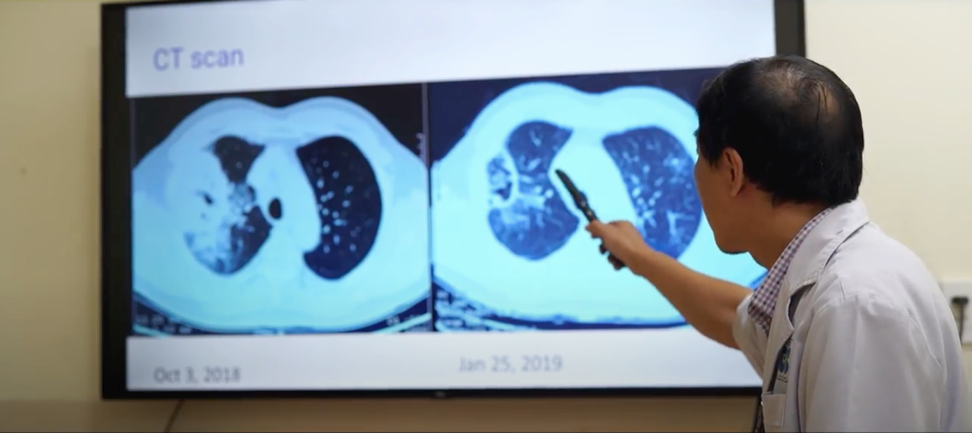 Kích thước khối u đã giảm đi nhanh chóng chỉ sau hơn 2 tháng điều trị bằng liệu pháp miễn dịch