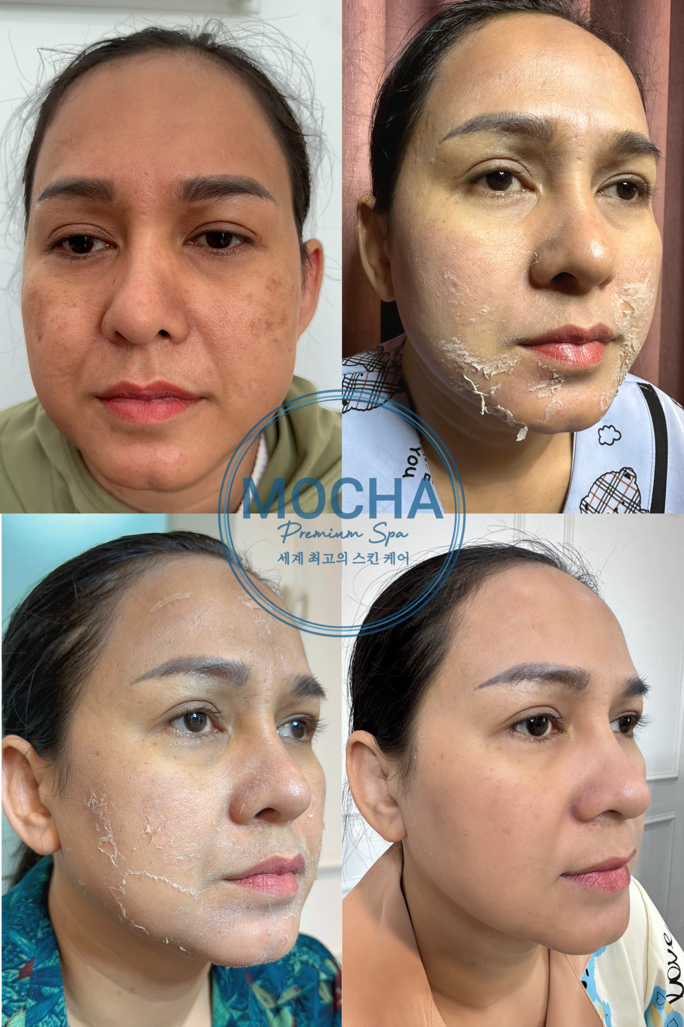 Peel da mang lại nhiều thay đổi bất ngờ cho làn da của bạn