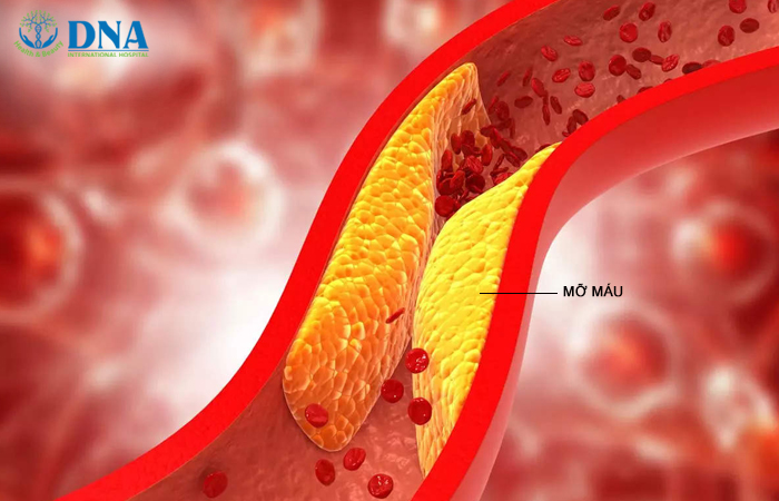 Mỡ máu xấu tăng cao lâu ngày bám vào thành mạch gây hẹp lòng mạch