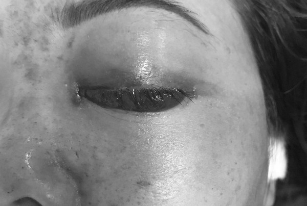 Khách bị mù mắt sau tiêm filler, chủ spa bị phạt 120 triệu đồng ảnh 1