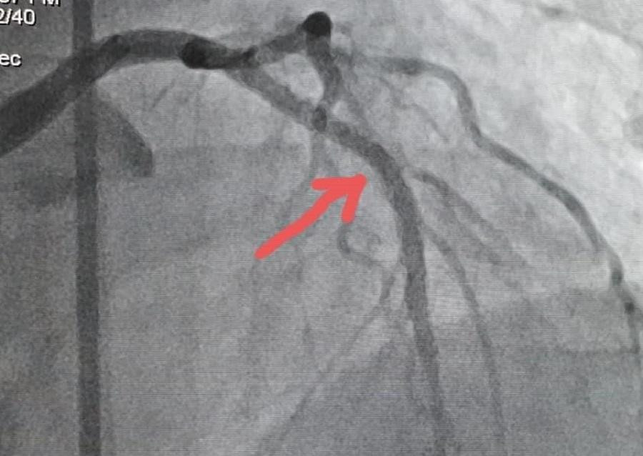 Hình ảnh động mạch vành của bệnh nhân trước và sau khi được thông tim đặt stent