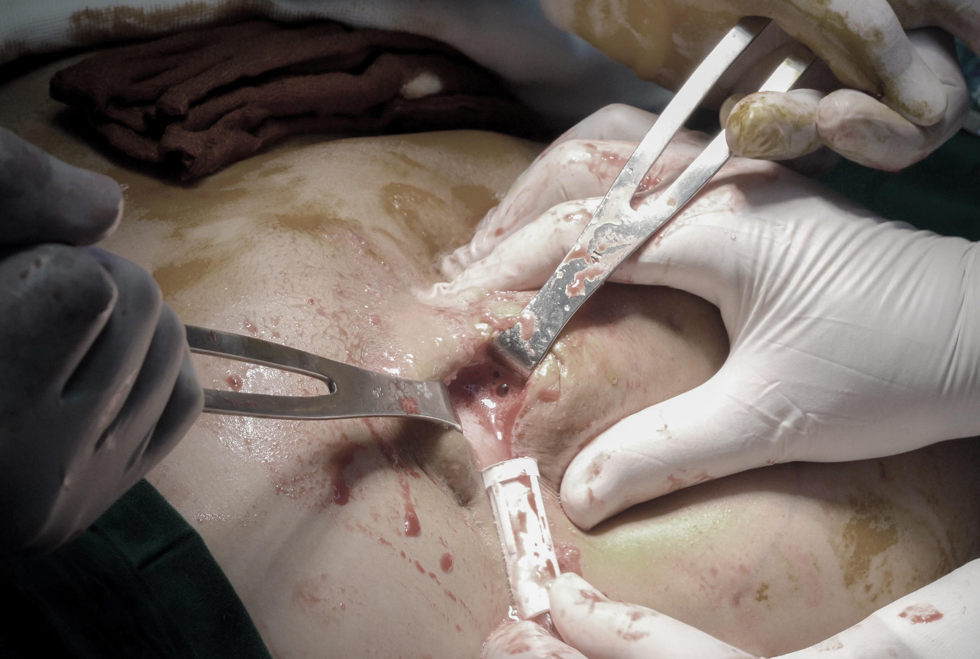 Ổ dịch hoại tử sau tai nạn bơm chất làm đầy khiến bệnh nhân phải cắn răng chịu đựng nhiều tháng qua.