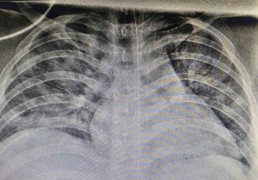 Thời điểm mới nhập viện, phổi bệnh nhân bị tổn thương rất nặng trên nền cơ địa béo phì mắc COVID-19. Thời điểm mới nhập viện, phổi bệnh nhân bị tổn thương rất nặng trên nền cơ địa béo phì mắc COVID-19.