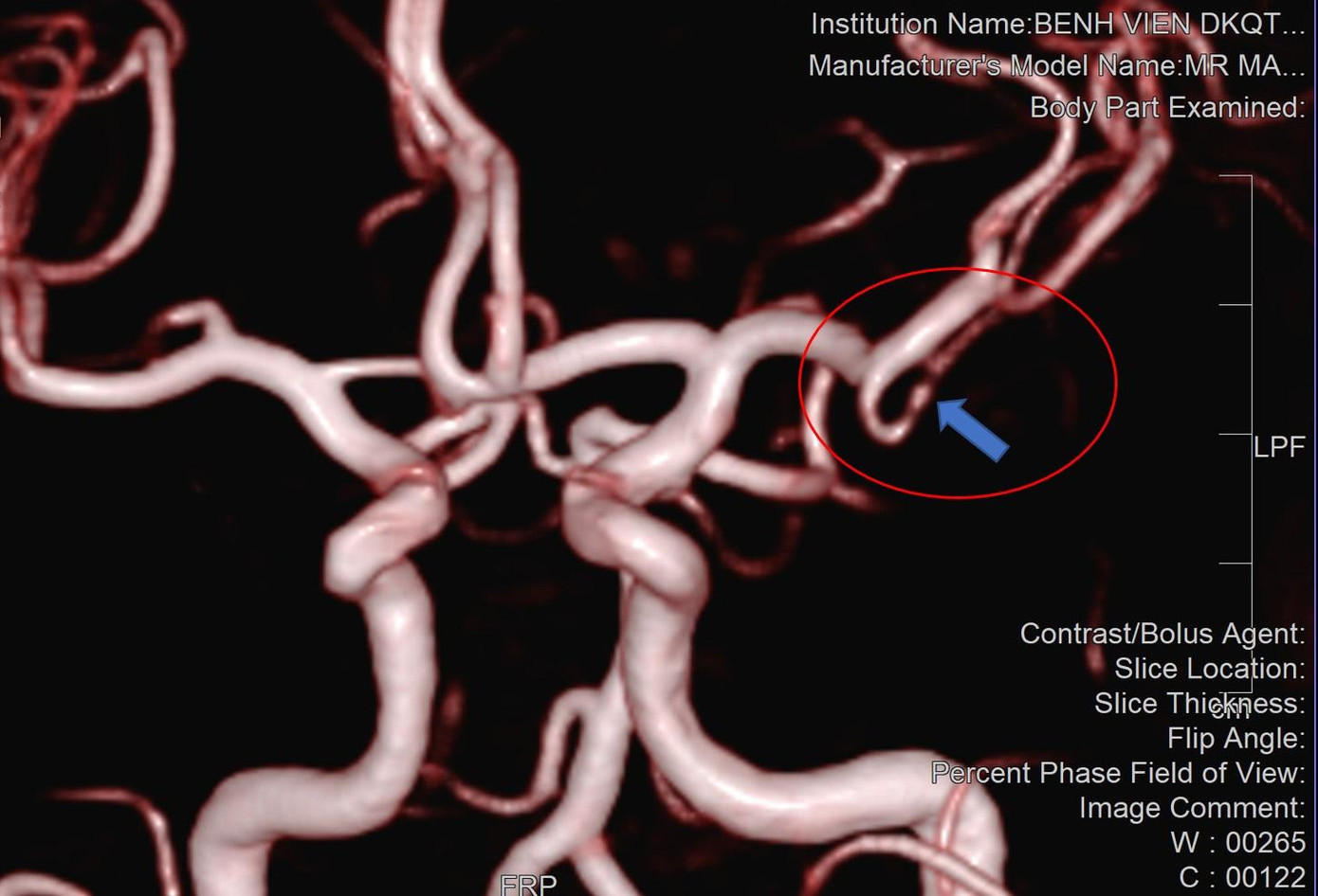 Bệnh nhân bị hẹp mạch máu não đã gọi điện nhờ BS Trần Chí Cường hỗ trợ chuyên môn. Bệnh nhân bị hẹp mạch máu não đã gọi điện nhờ BS Trần Chí Cường hỗ trợ chuyên môn.