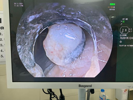 Kíp can thiệp thắt giãn vỡ tĩnh mạch thực quản do BS. Trần Thanh Hà, Trung tâm Tiêu hóa Gan mật thực hiện. Ảnh: Bệnh viện cung cấp Kíp can thiệp thắt giãn vỡ tĩnh mạch thực quản do BS. Trần Thanh Hà, Trung tâm Tiêu hóa Gan mật thực hiện. Ảnh: Bệnh viện cung cấp