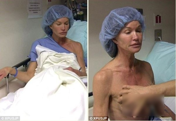 Cận cảnh ‘trùng tu’ bộ ngực giả của siêu mẫu Mỹ ảnh 5