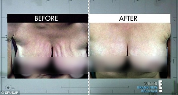 Cận cảnh ‘trùng tu’ bộ ngực giả của siêu mẫu Mỹ ảnh 7