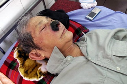 Ông Hà Văn Tự bị viêm nhiễm vách ngăn, phù nề và có dòi bên trong mũi. Ông Hà Văn Tự bị viêm nhiễm vách ngăn, phù nề và có giòi bên trong mũi