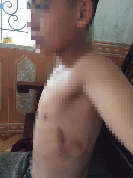 Phụ huynh xông vào trường đánh học sinh lớp 7 bầm tím sườn ảnh 1