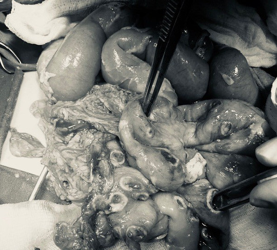 Kinh hãi, bé trai thủng tới 50 lỗ ở ruột do ấu trùng giun chó, mèo ảnh 1