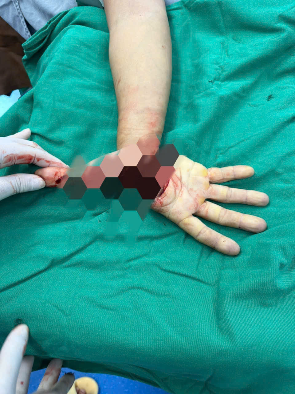 Bàn tay phải của bà L. bị đứt rời trước khi vào phòng phẫu thuật