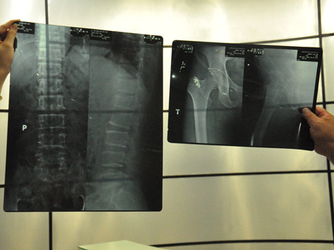 Một bệnh nhân bị các bác sĩ ghép xén phim X-quang ở BV. ảnh: L.N. một bệnh nhân bị các bác sĩ ghép xén phim X-quang ở BV (ảnh nhỏ) ảnh: L.N